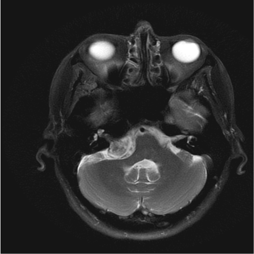 <p>Cerebellopontine Angle (CPA) Tumor, Magnetic Resonance Image. This image shows a T2-weighted head MRI of a CPA tumor.</p>