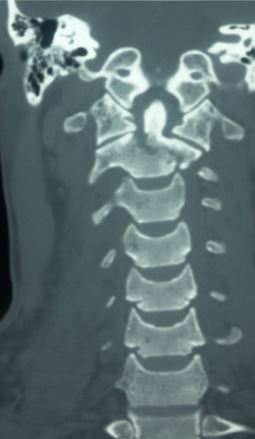 <p>Odontoid Fracture, Anterior Posterior