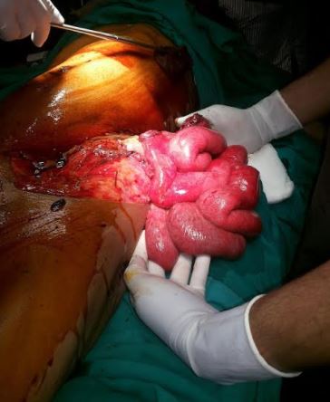 <p>Evisceration From Penetrating Abdominal Injury