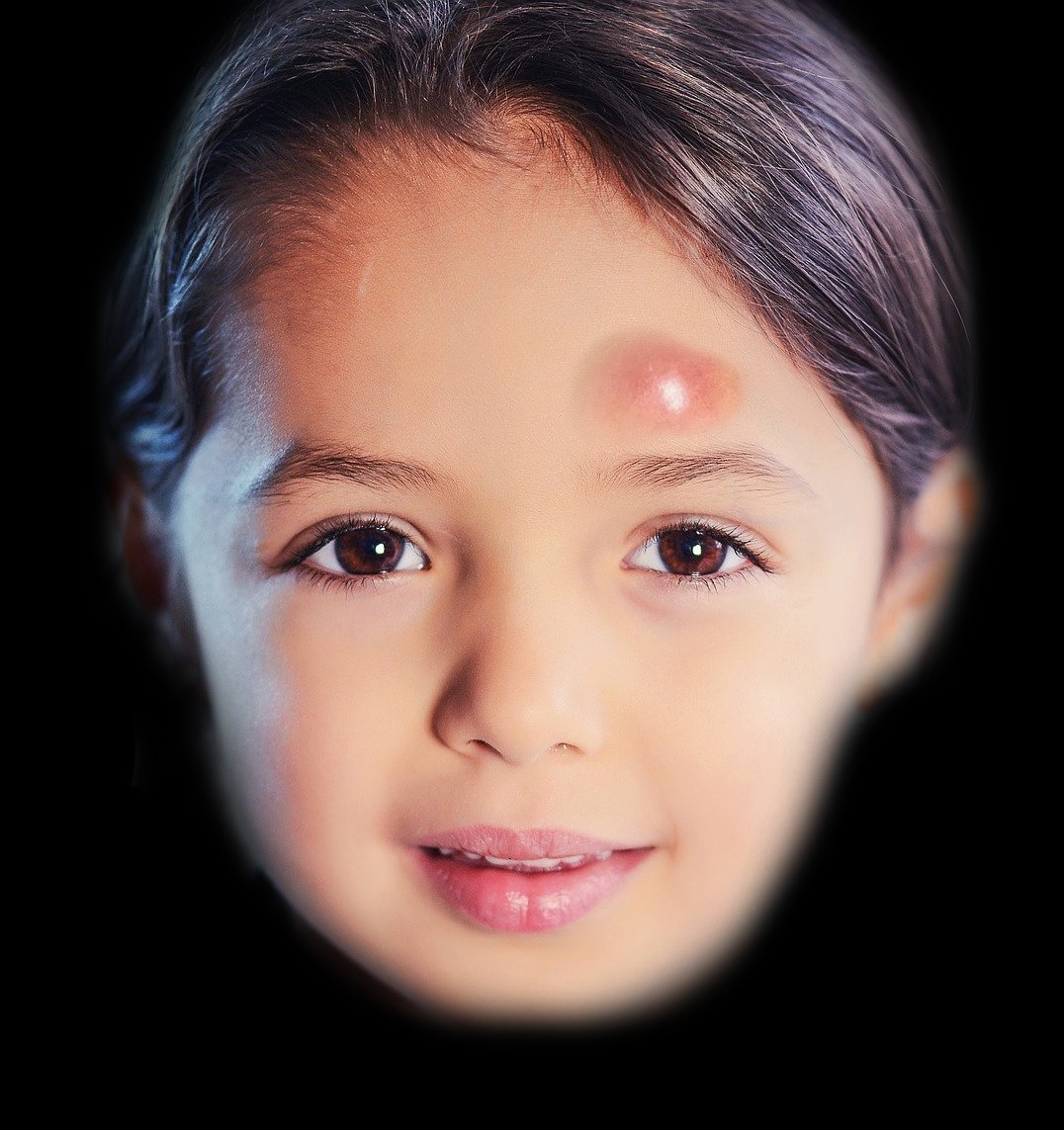 <p>Example of a Pott Puffy Tumor.</p>
