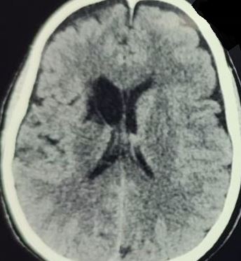 <p>Recurrent Artery of Heubner Stroke on Computed Tomography