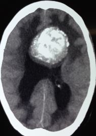 <p>Oligodendroglioma, Computed Tomography Scan
