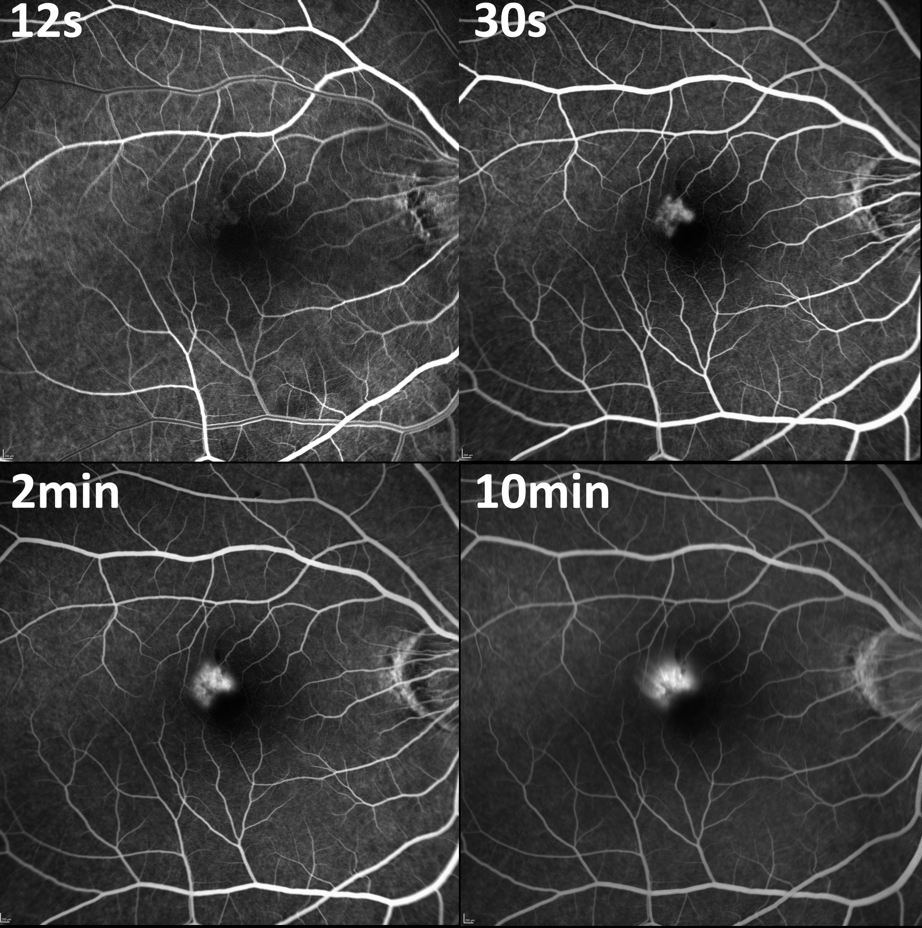 <p>Fluorescein Angiogram Demonstrating Myopic Choroidal Neovascular Membrane