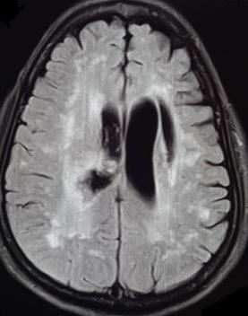<p>Fazekas Grade 3 White Matter Lesions. Fazekas grade&nbsp;3 white matter lesions in a case of stroke.</p>