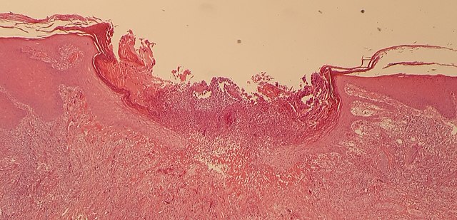 Histopathology of chondrodermatitis nodularis chronica helicis