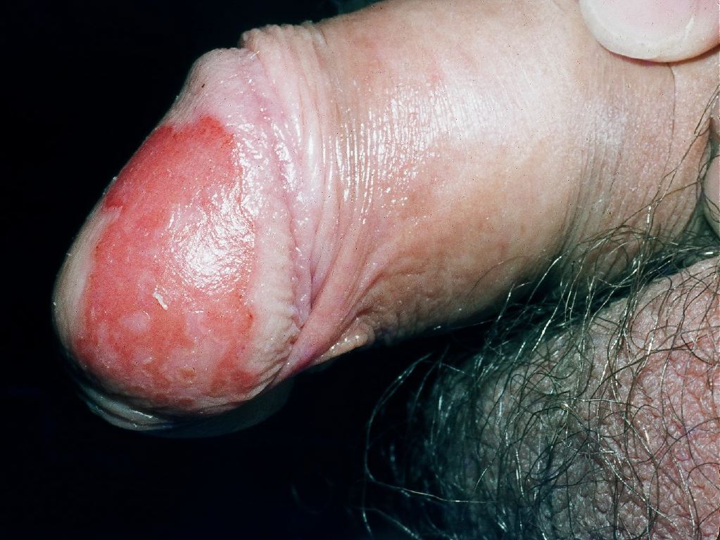<p>Balanitis. Inflammation of the glands of the penis.</p>