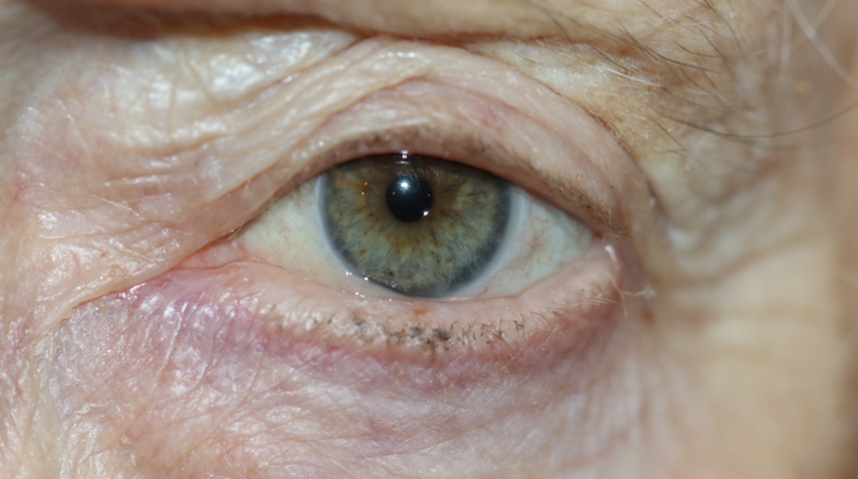 <p>Conjunctivochalasis, Grade 2. The image shows a grade 2 conjunctivochalasis in a female patient.</p>