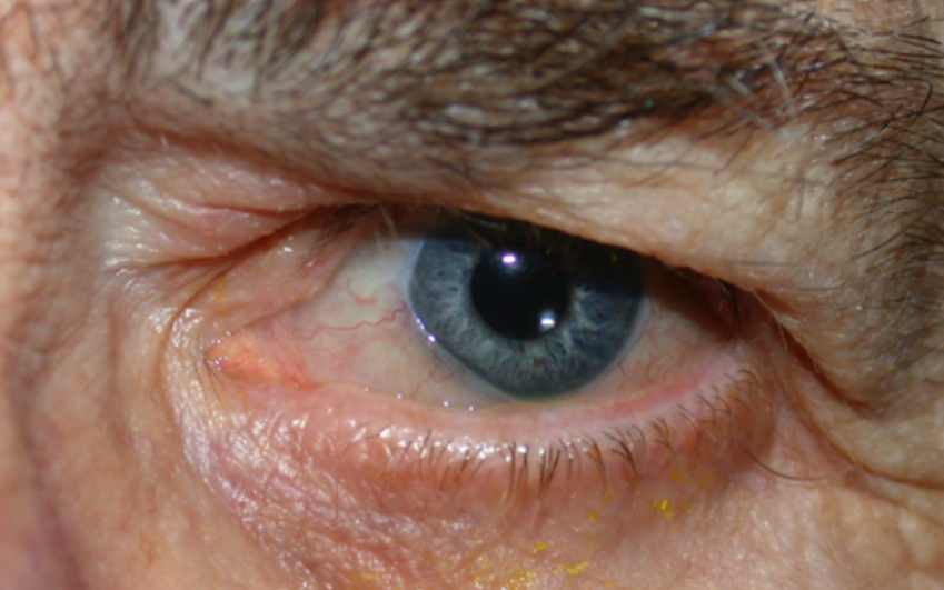 <p>Conjunctivochalasis, Left Eye.&nbsp;This image portrays&nbsp;conjunctivochalasis in the left eye of a male patient.</p>