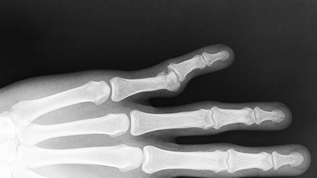 <p>Left Proximal Interphalangeal Dislocation, Radiograph