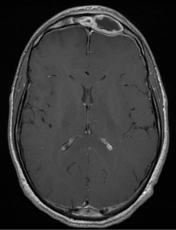 <p>Pott Puffy Tumor With Frontal Sinusitis.</p>