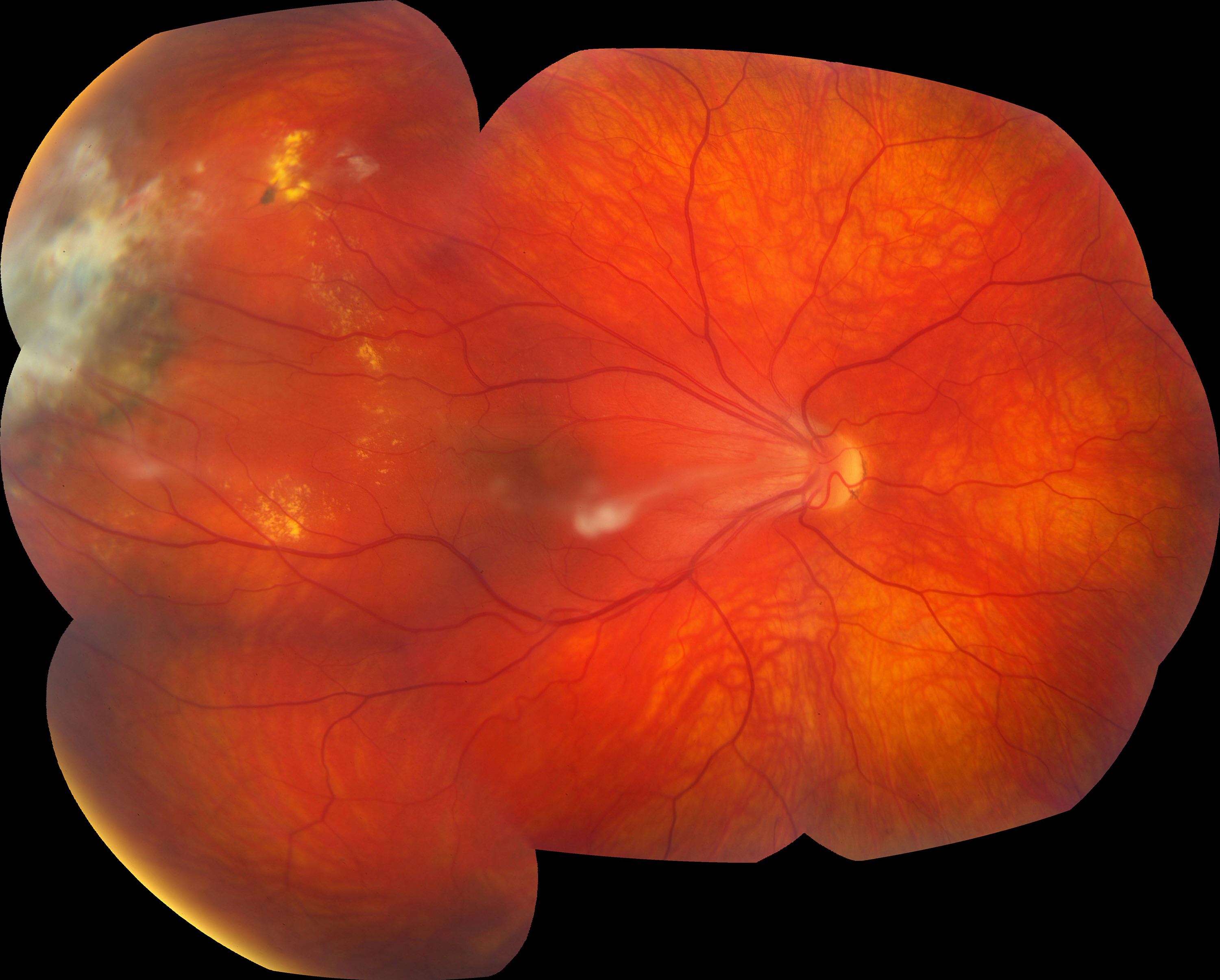 <p>Macular Edema in Familial Exudative Vitreoretinopathy