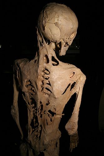 Skelton of an individual who suffered from fibrodysplasia ossificans progressiva.