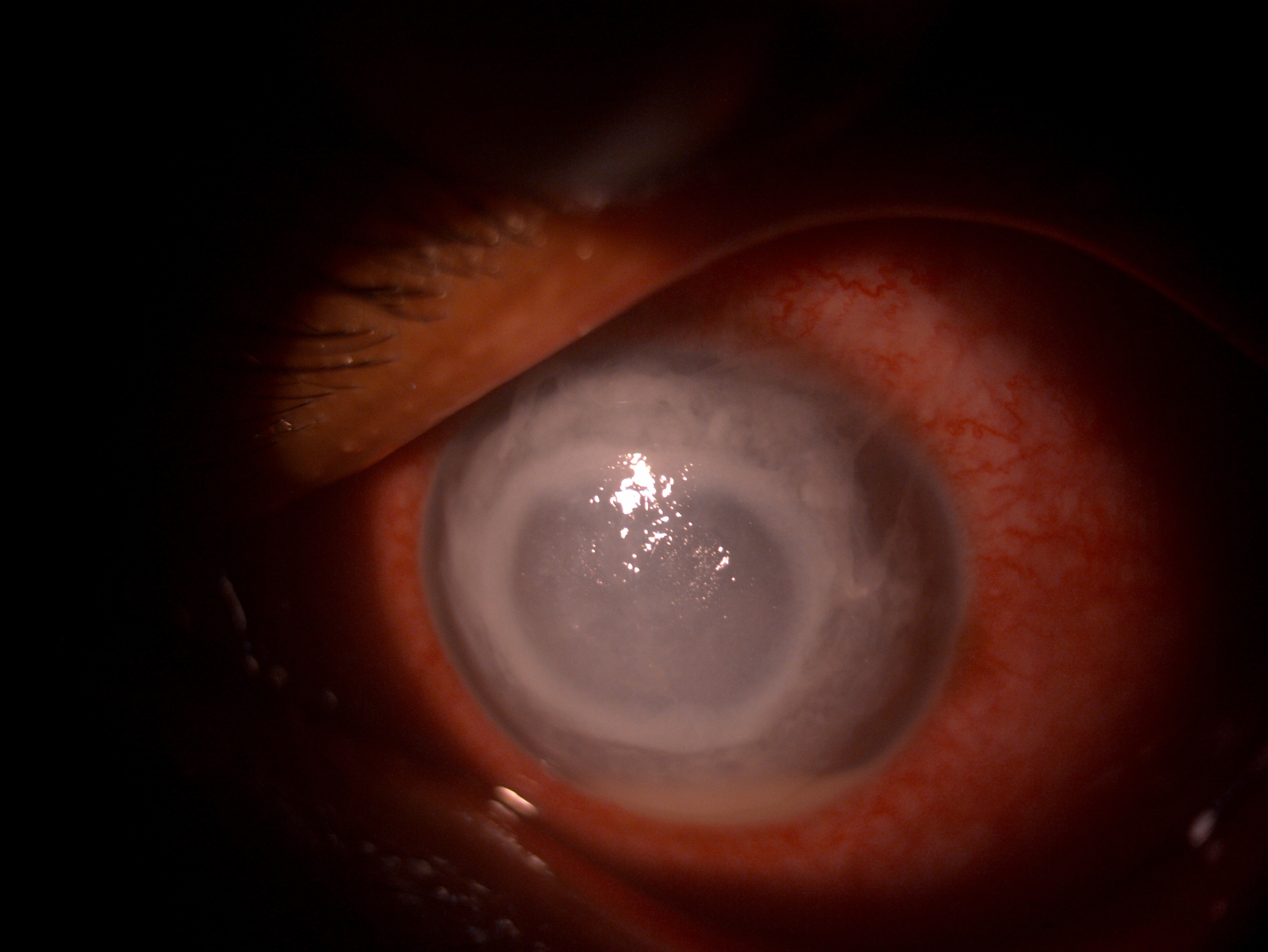 Slit lamp image of the patient depicting Klebsiella endogenous endophthalmitis in a patient with chronic urinary tract infect
