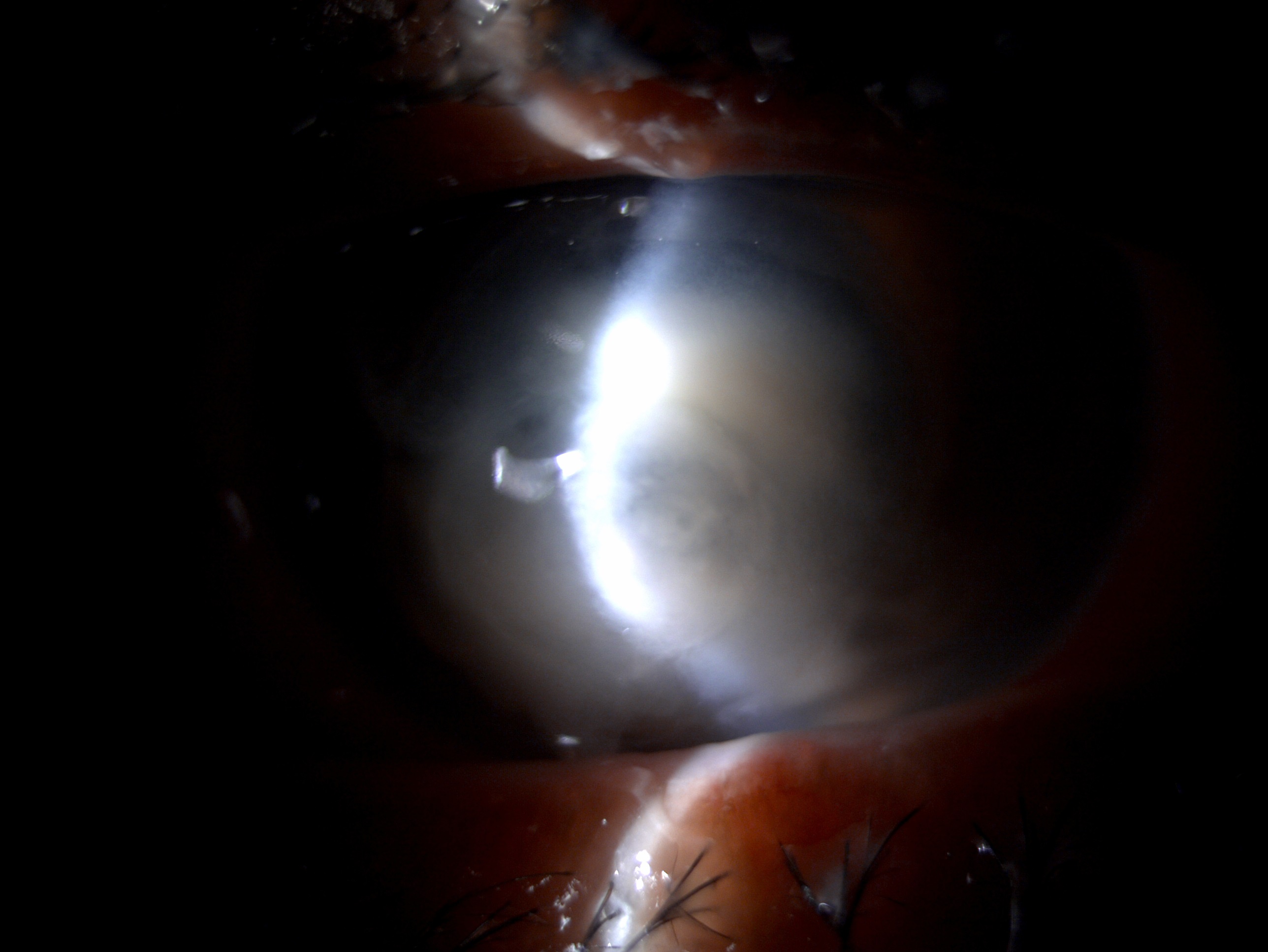 Slit lamp image of the patient depicting corneal melt, full thickness corneal infiltrate in a patient with pseudomonas endoge