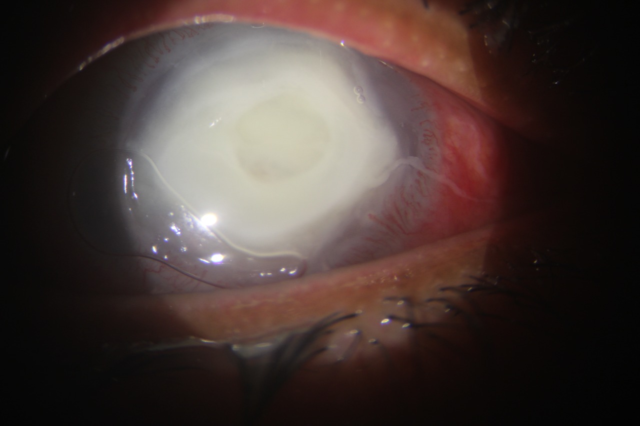 Slit lamp image of the patient depicting 8x8 mm full thickness corneal infiltrate with corneal melt, corneal abscess in a pat