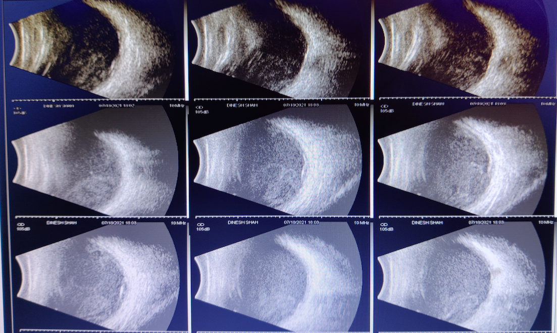 Digital B Scan images of the patient with endogenous endophthalmitis depicting IOL reverberation, multiple dot, and membranou