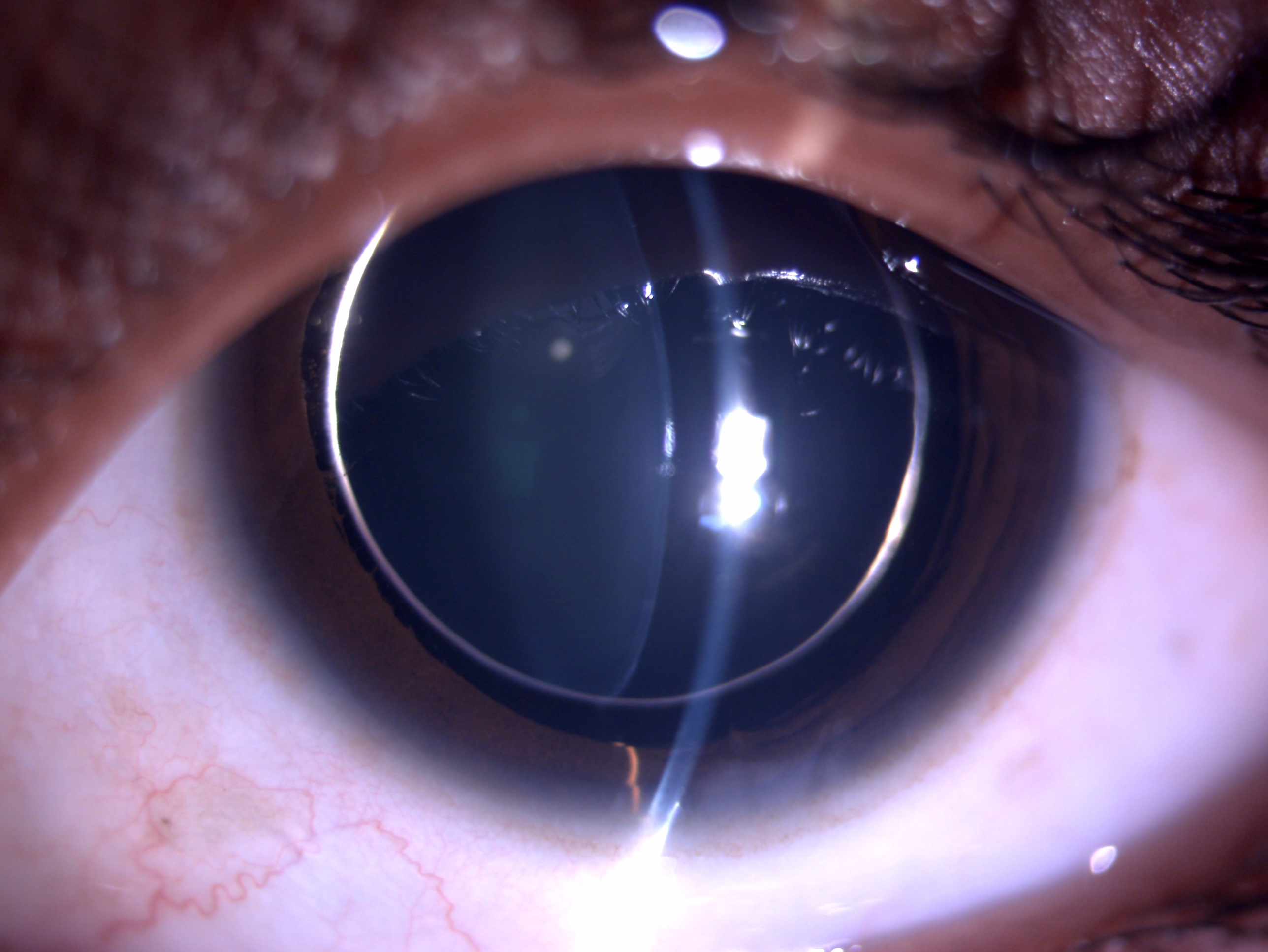 Slit lamp image of the patient depicting small globular, spherical clear lens with 360 deficient zonules and equator of lens 