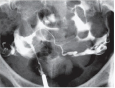 <p>Classic T-shaped Uterus on a Hysterosalpingogram