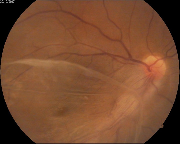 <p>Familial Exudative Vitreoretinopathy&mdash;Preoperative Fundus Photograph.</p>
