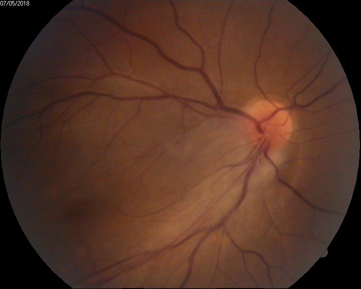<p>Familial Exudative Vitreoretinopathy&mdash; Postoperative Fundus Photograph.</p>