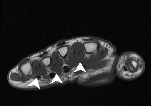 <p>Dorsal Interossei&nbsp;on Magnetic Resonance Imaging