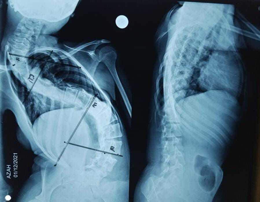 <p>Scoliosis With Duchenne Muscular Dystrophy