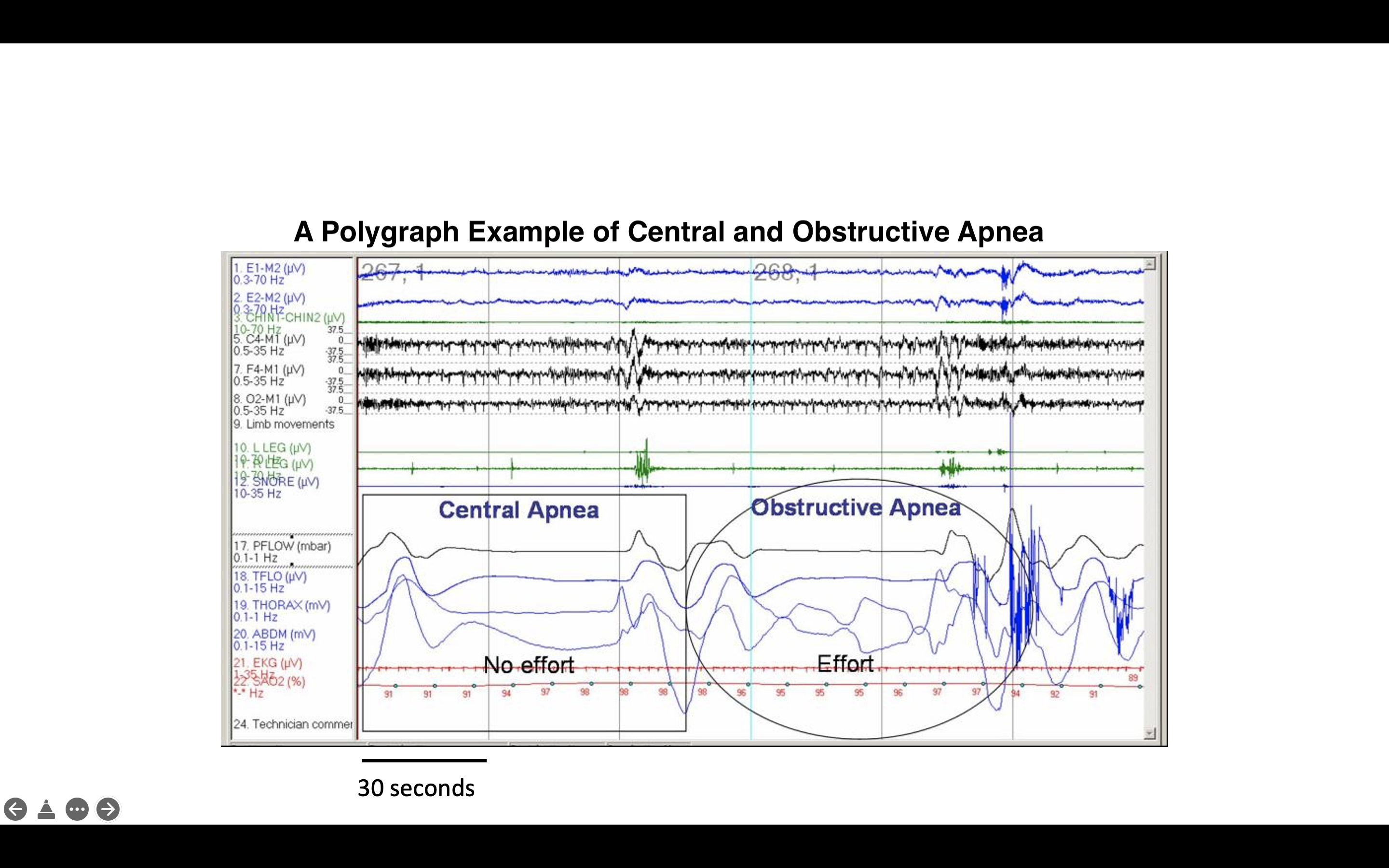 <p>Polysomnography Showing Central and Obstructive Sleep Apneas