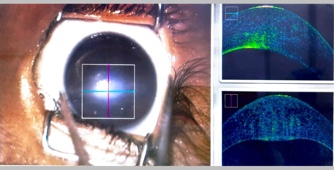 This is a clinical picture of the Peters anomaly a case, showing central corneal opacity with clear periphery