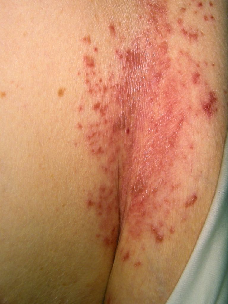 <p>Candida-Associated Intertrigo.</p>