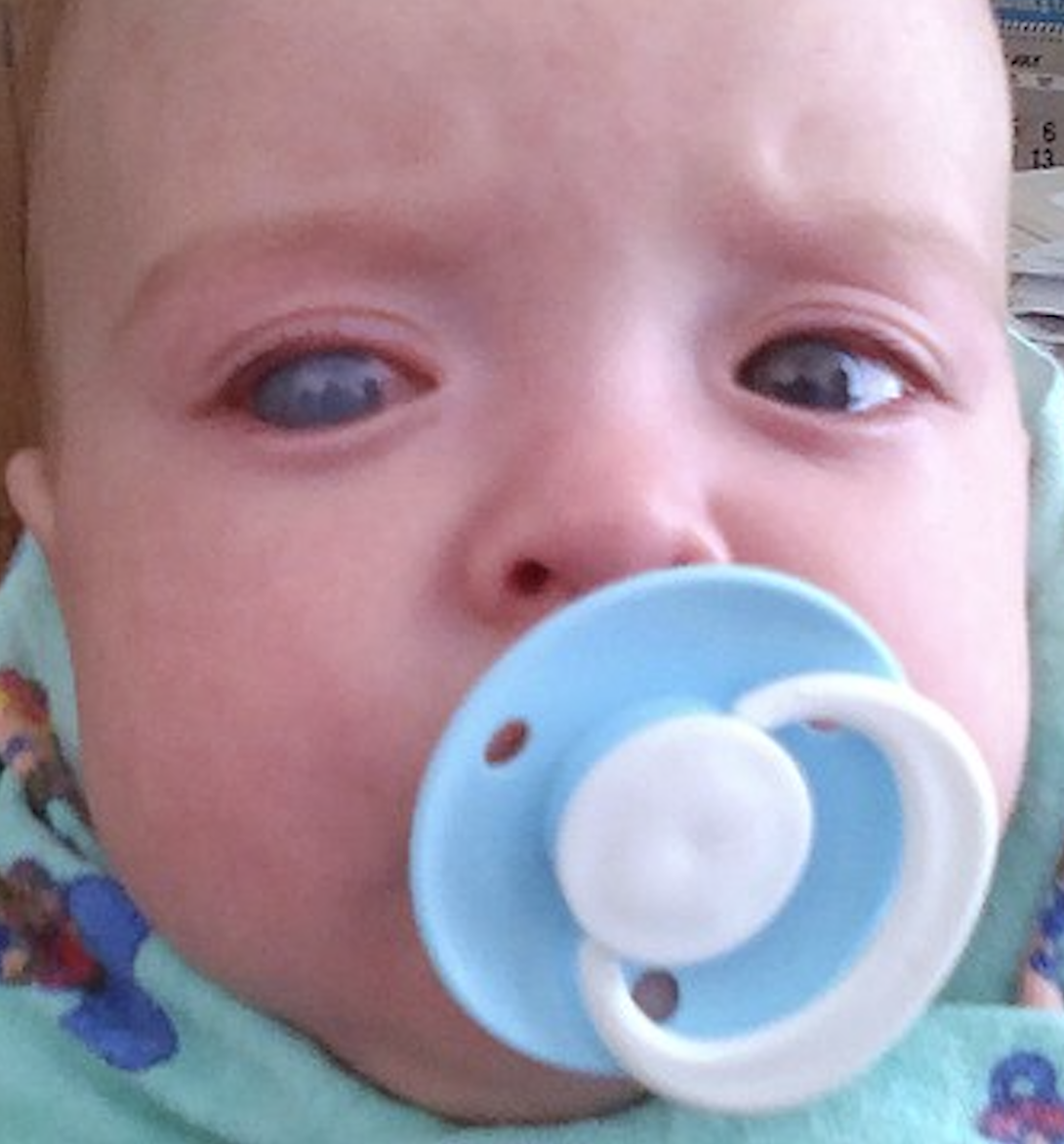 <p>Buphthalmos. The image&nbsp;shows an infant with right-sided buphthalmos.</p>