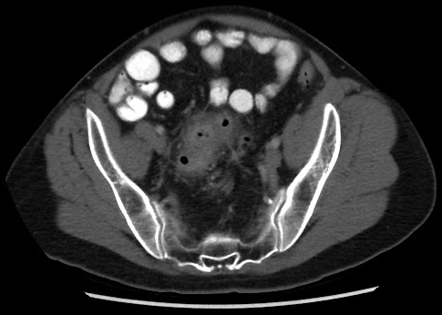 Acute uncomplicated diverticulitis