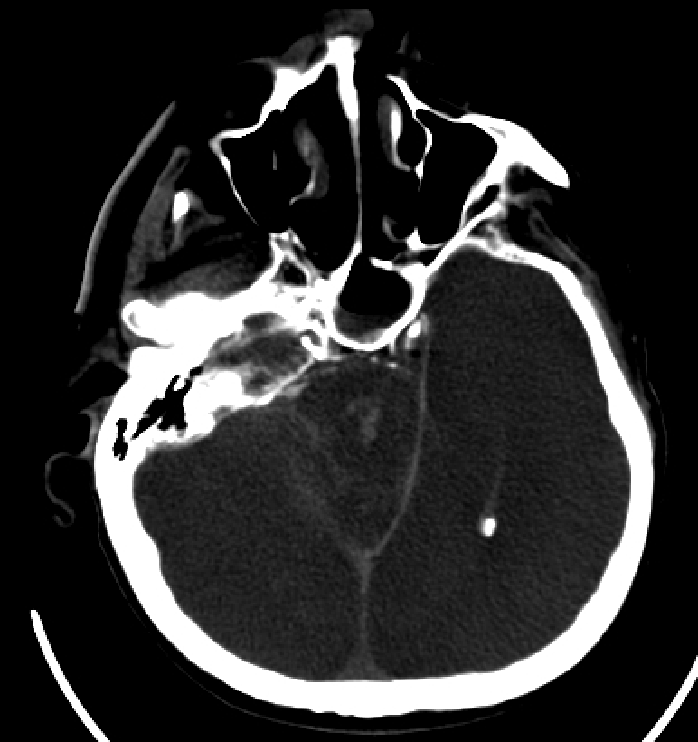 <p>Duret Hemorrhage, Computed Tomography Scan