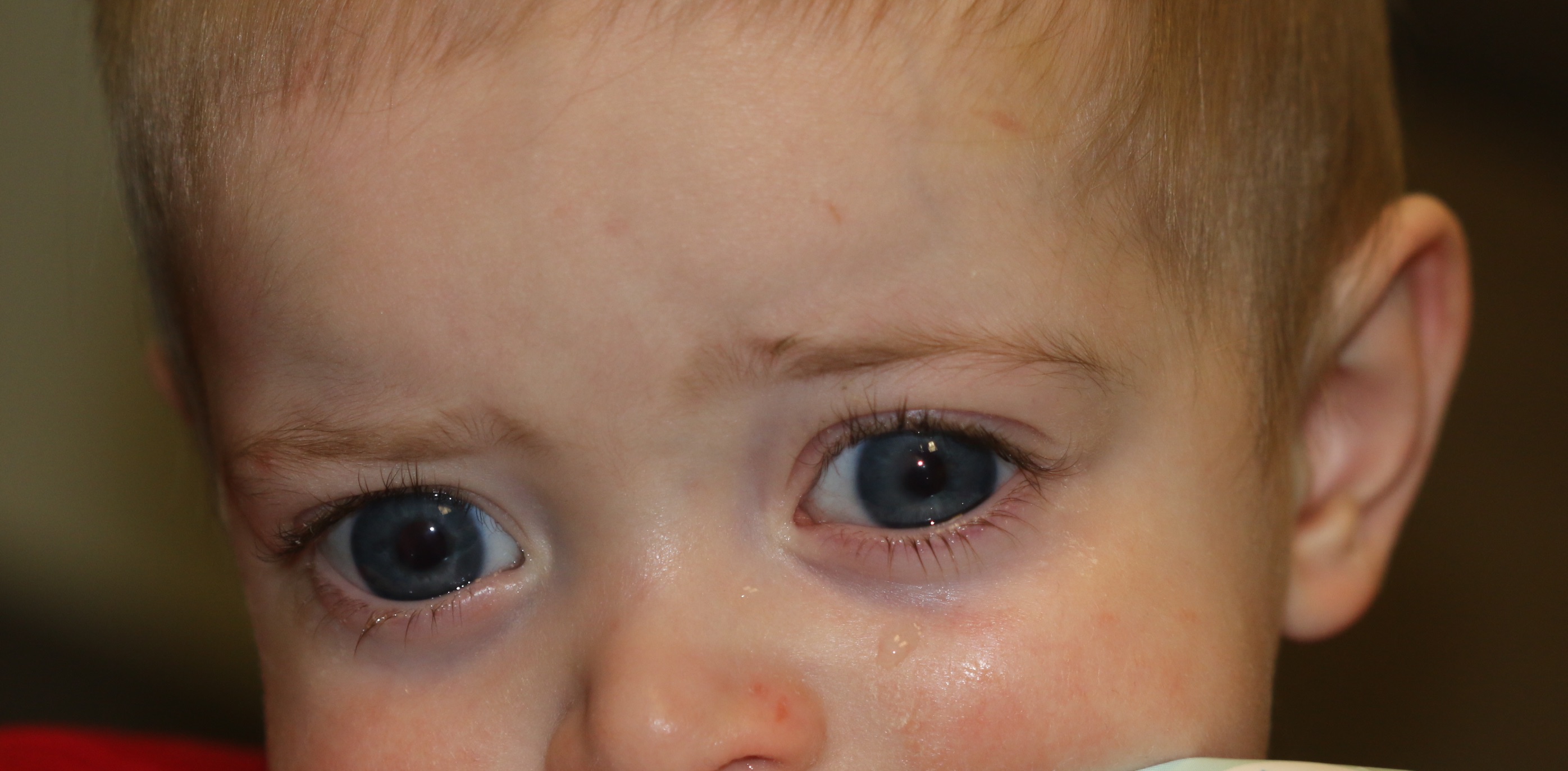 <p>Buphthalmos with Bilateral Tearing and Light Sensitivity
