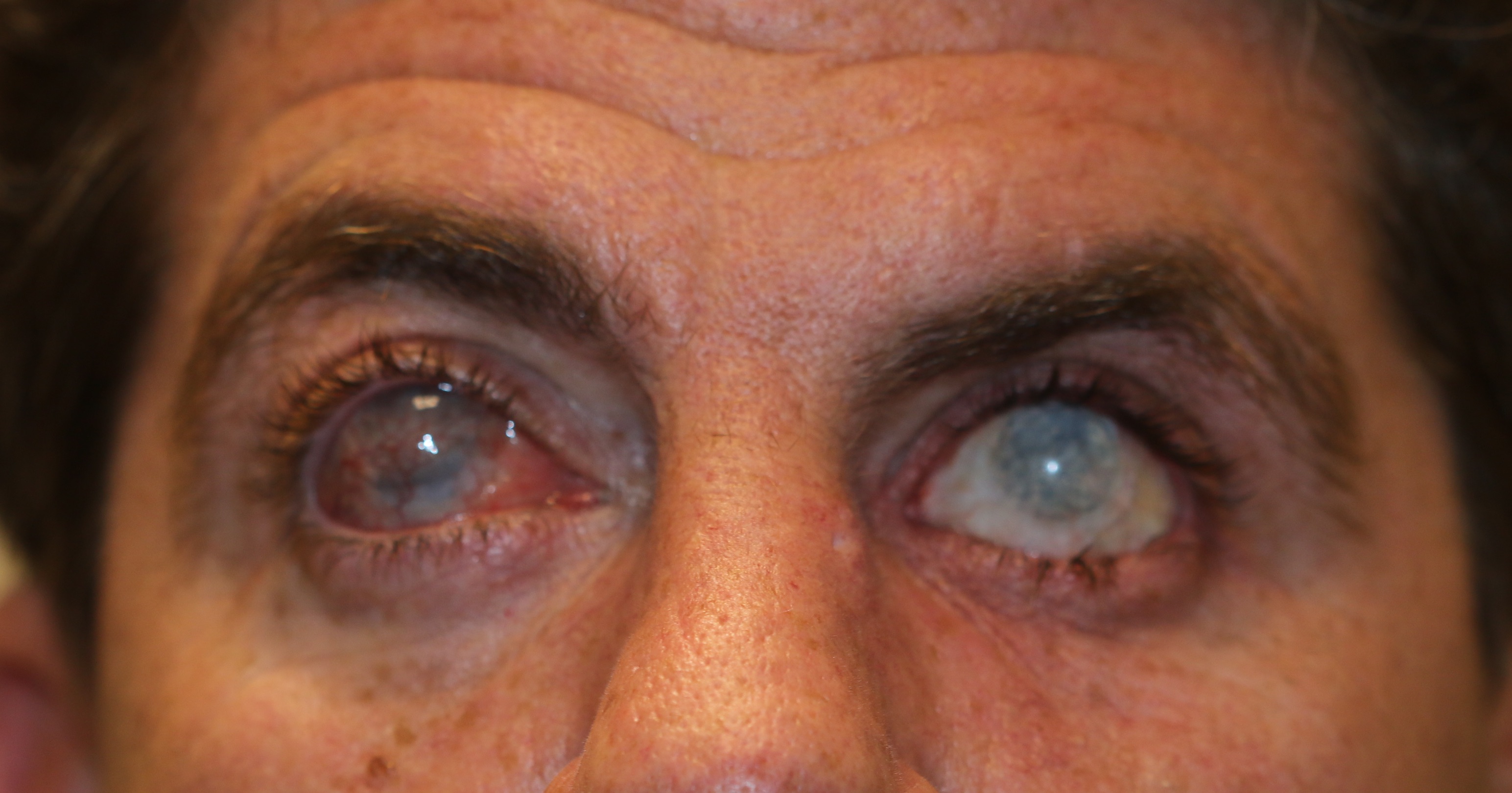 <p>Buphthalmos in an Adult