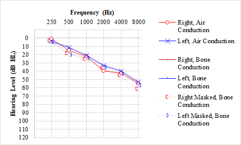 <p>Audiogram, Presbycusis