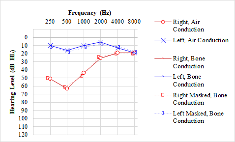 <p>Hearing Loss, M&eacute;ni&egrave;re Disease