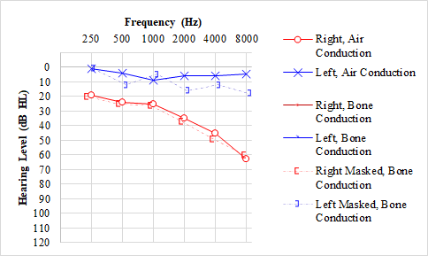 <p>Audiogram, Vestibular Schwannoma/Acoustic Neuroma