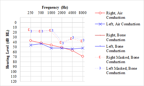 <p>Audiogram, Otosclerosis