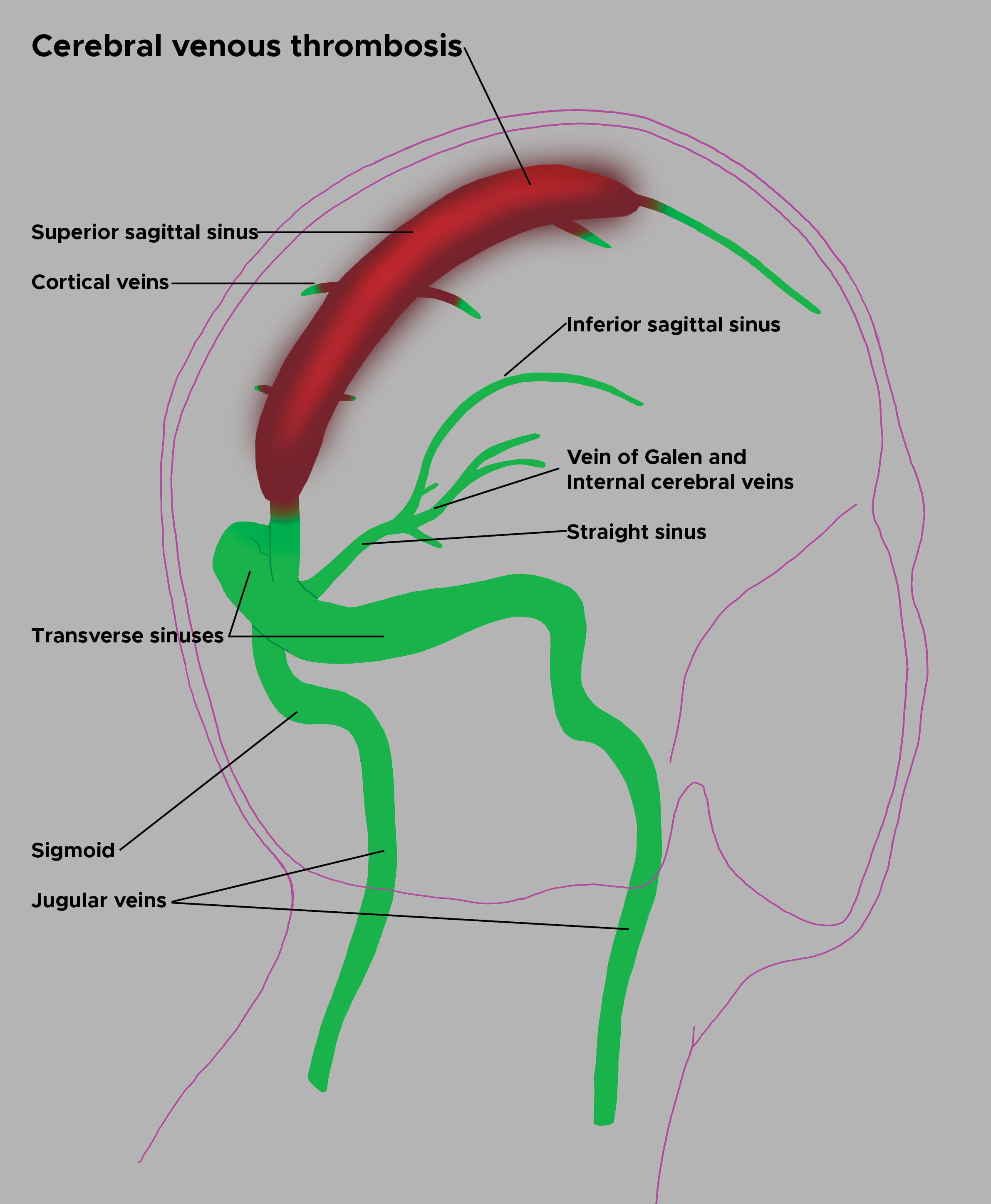 <p>Cerebral Venous Thrombosis Illustration