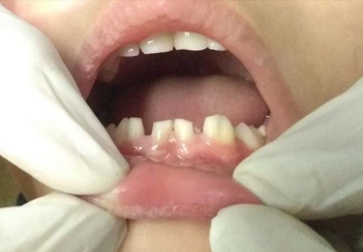 <p>Dental Fusion in Primary Dentition