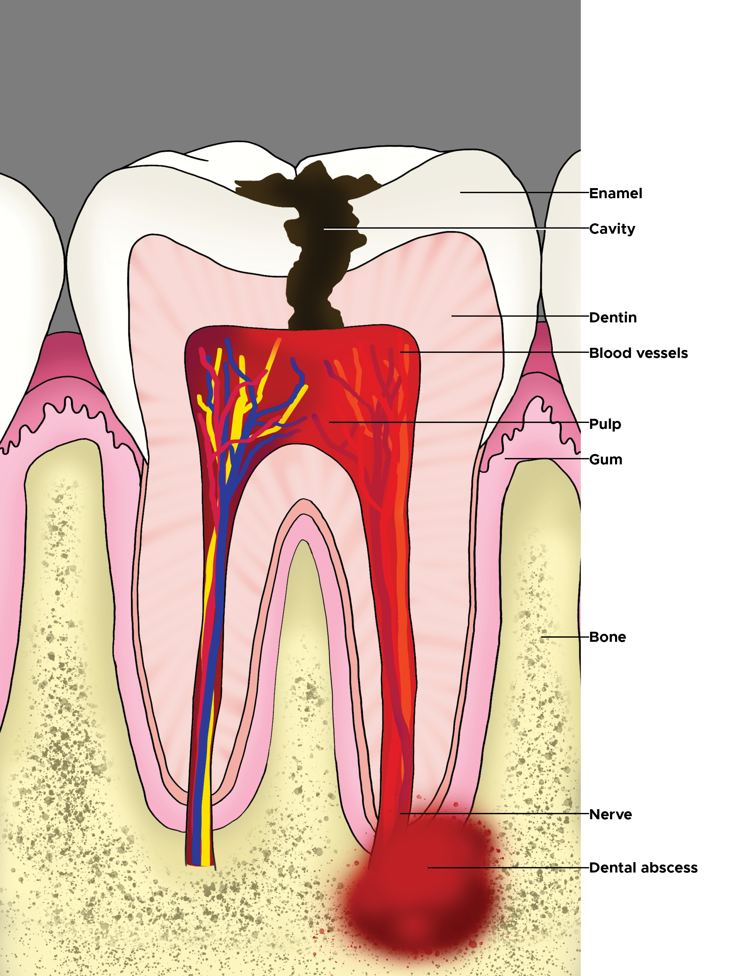 <p>Illustration of a Molar With Cavity and a Dental Abscess