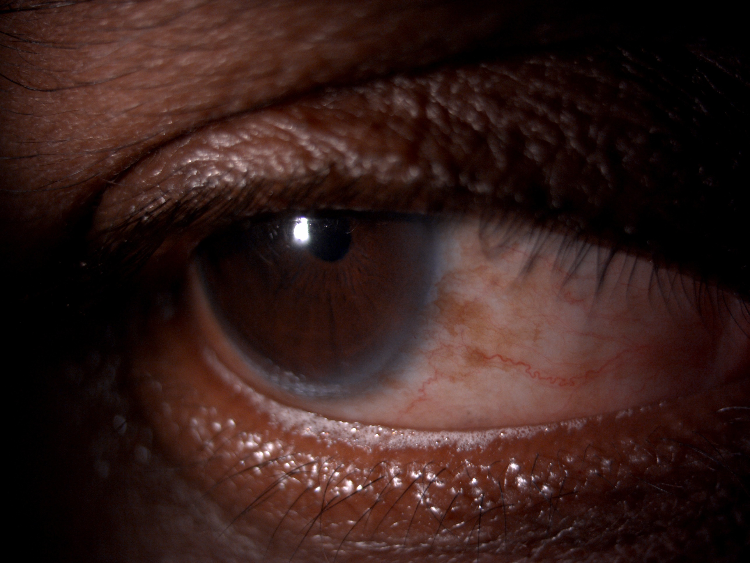 <p>Lower Eyelid Frothing