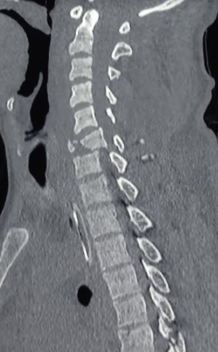 <p>Fracture Dislocation of Cervical Spine</p>