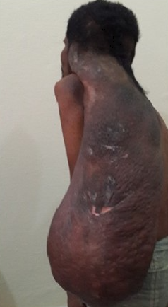 <p>Solitary Giant Neurofibroma