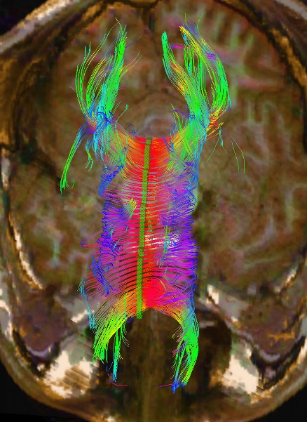 <p>Diffusion Tensor Imaging of Corpus Callosum</p>
