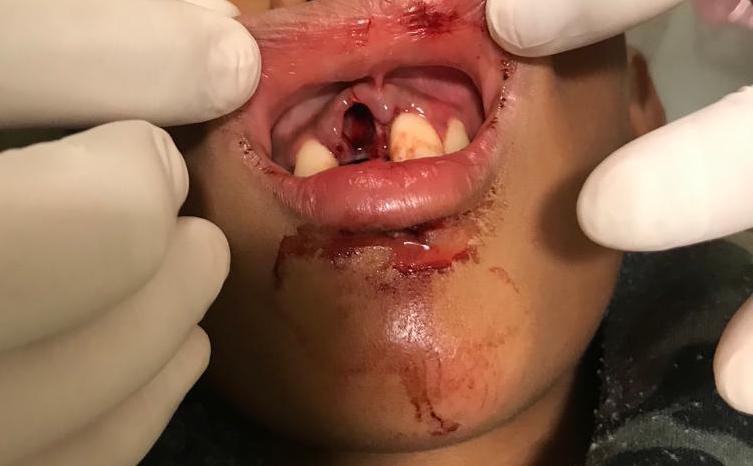 <p>Tooth Avulsion, Upper Right Central Incisor.</p>