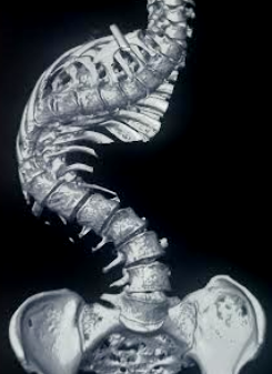 <p>Scoliotic Spine