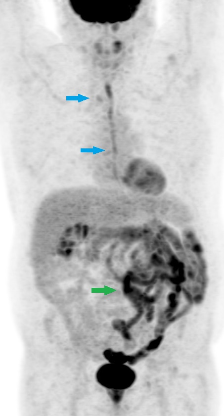 <p>Esophagitis on Advanced Nuclear Imaging