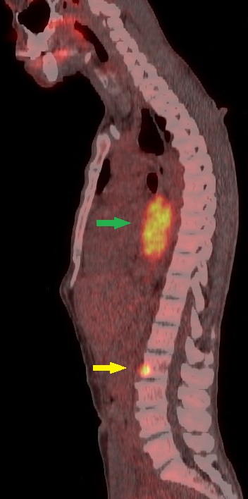 <p>Occult Metastasis on Advanced Nuclear Imaging