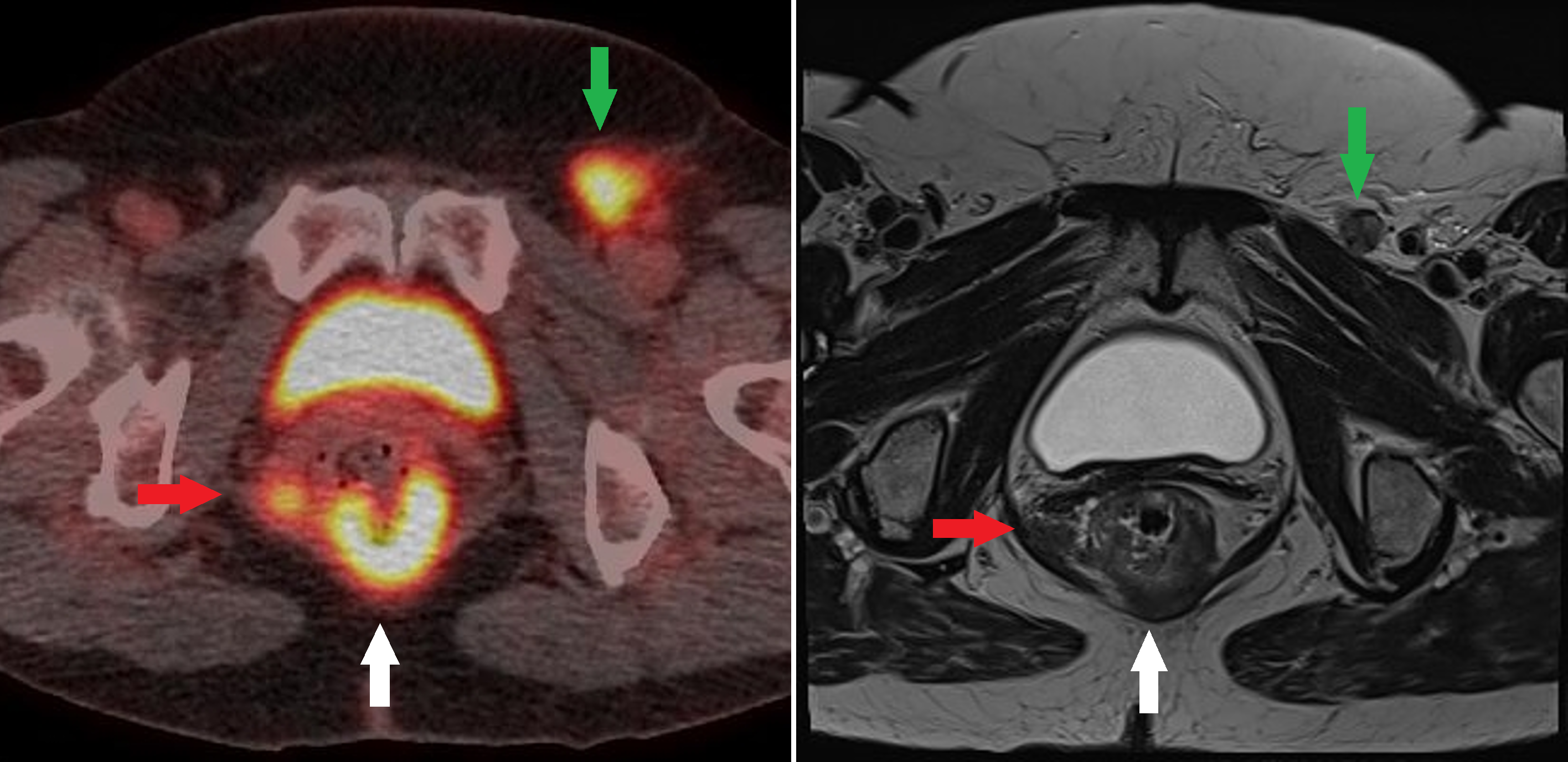 <p>Anal Squamous Cell Carcinoma
